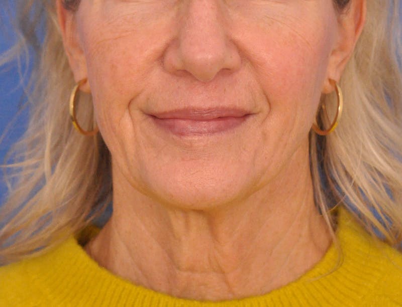 Profound Laser Before & After Gallery - Patient 312847 - Image 2