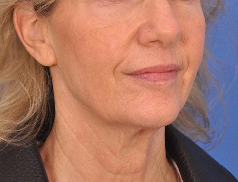 Profound Laser Before & After Gallery - Patient 312847 - Image 3