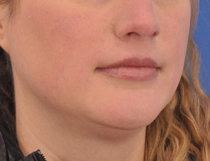 Lip Filler Before & After Gallery - Patient 310772 - Image 3