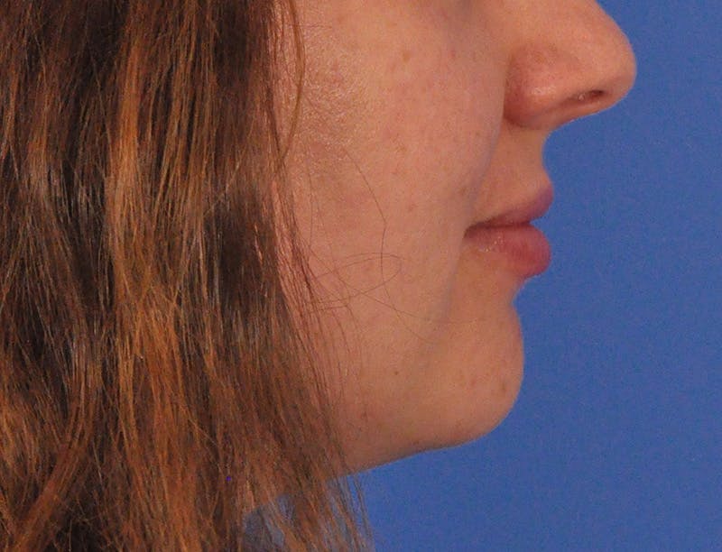 Lip Filler Before & After Gallery - Patient 296687 - Image 6