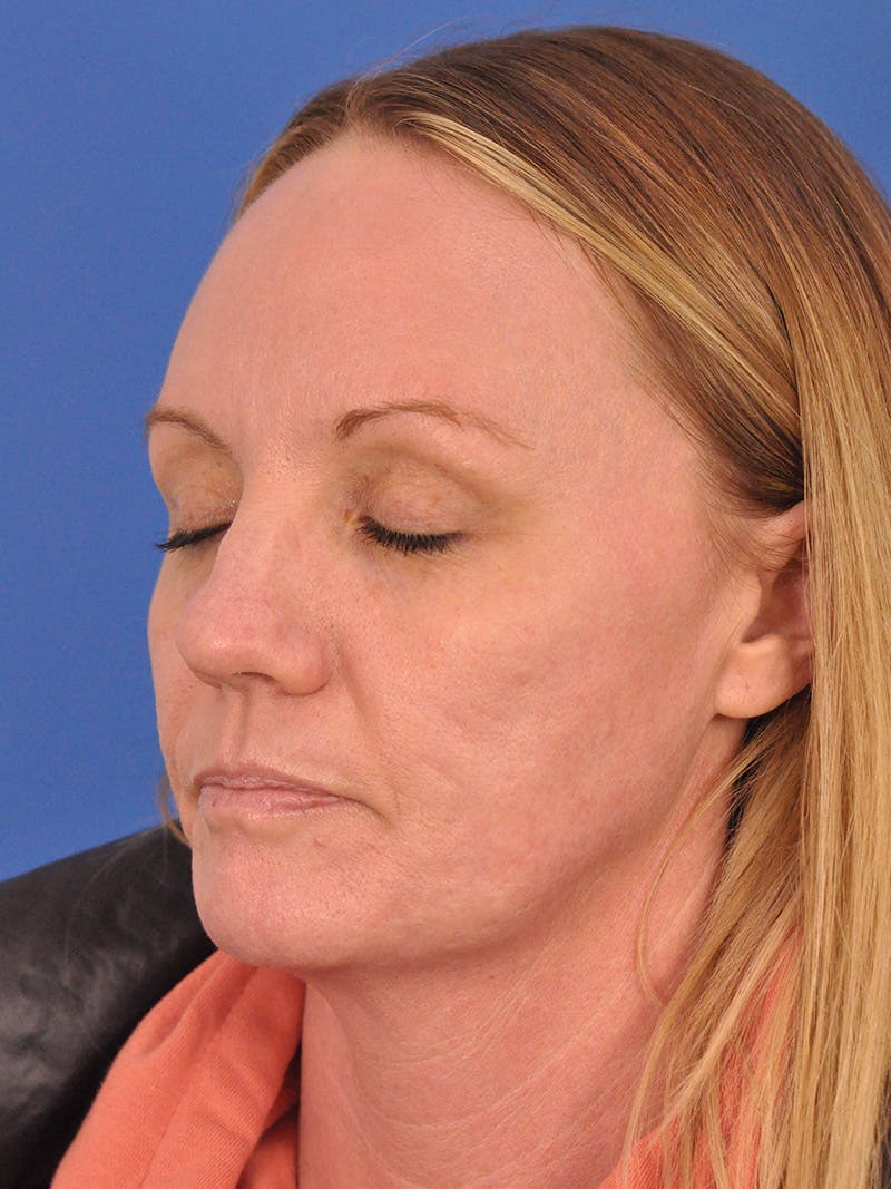 Acne Scars Before & After Gallery - Patient 147868 - Image 7