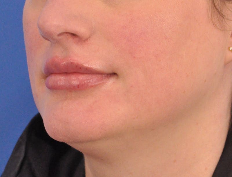 Lip Filler Before & After Gallery - Patient 310772 - Image 8