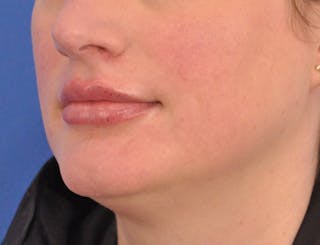 Lip Filler Before & After Gallery - Patient 310772 - Image 8