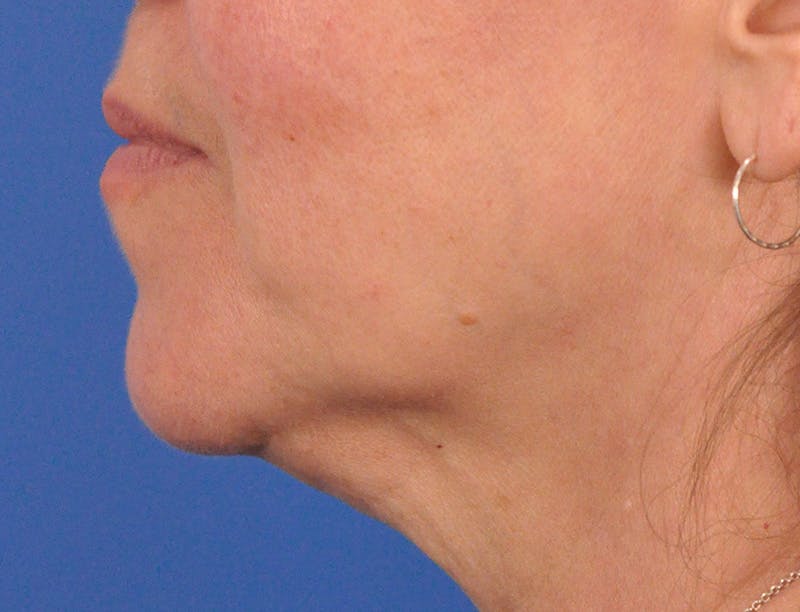 Lip Filler Before & After Gallery - Patient 237994 - Image 9