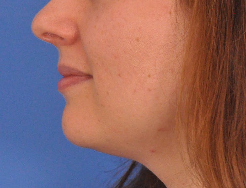 Lip Filler Before & After Gallery - Patient 296687 - Image 9