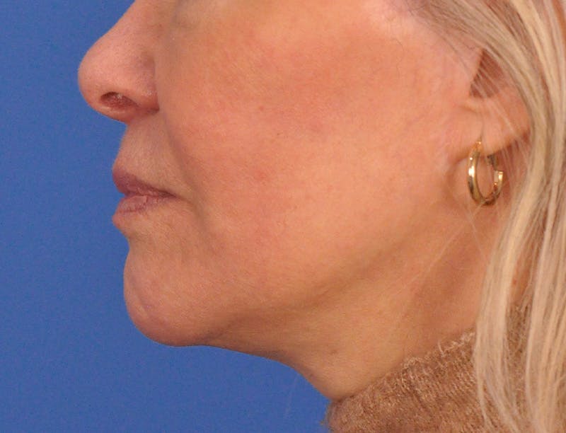 Lip Filler Before & After Gallery - Patient 325554 - Image 10