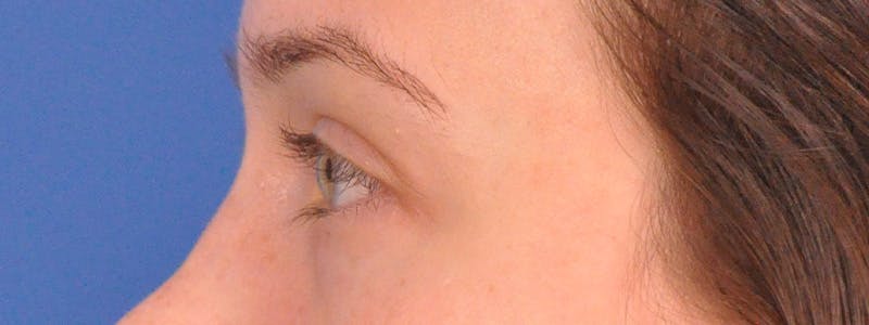 Tear Trough Filler Before & After Gallery - Patient 401813 - Image 10