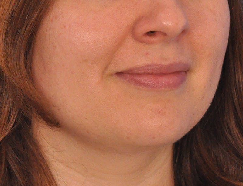 Lip Filler Before & After Gallery - Patient 296687 - Image 3