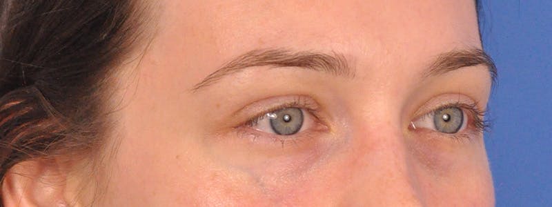 Tear Trough Filler Before & After Gallery - Patient 401813 - Image 4