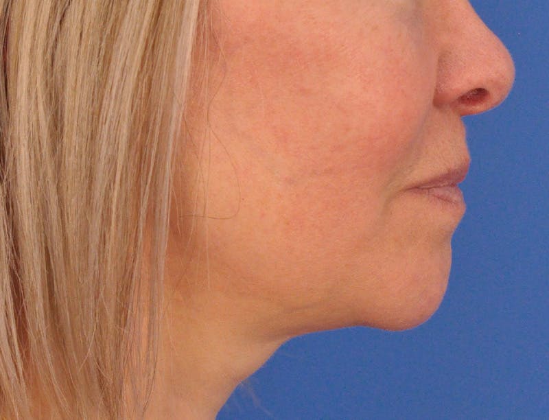 Lip Filler Before & After Gallery - Patient 325554 - Image 5