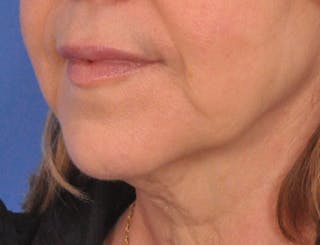 Lip Filler Before & After Gallery - Patient 237994 - Image 8