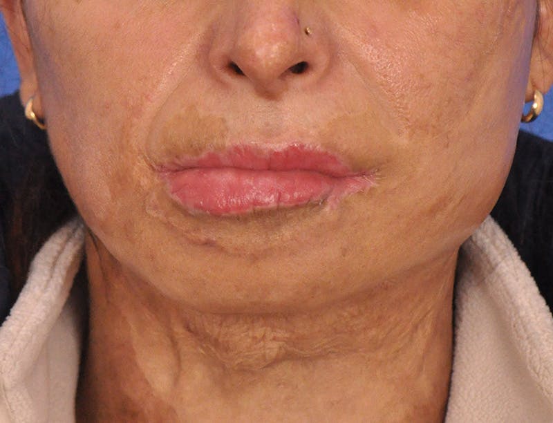 Lip Lift Before & After Gallery - Patient 380904 - Image 1