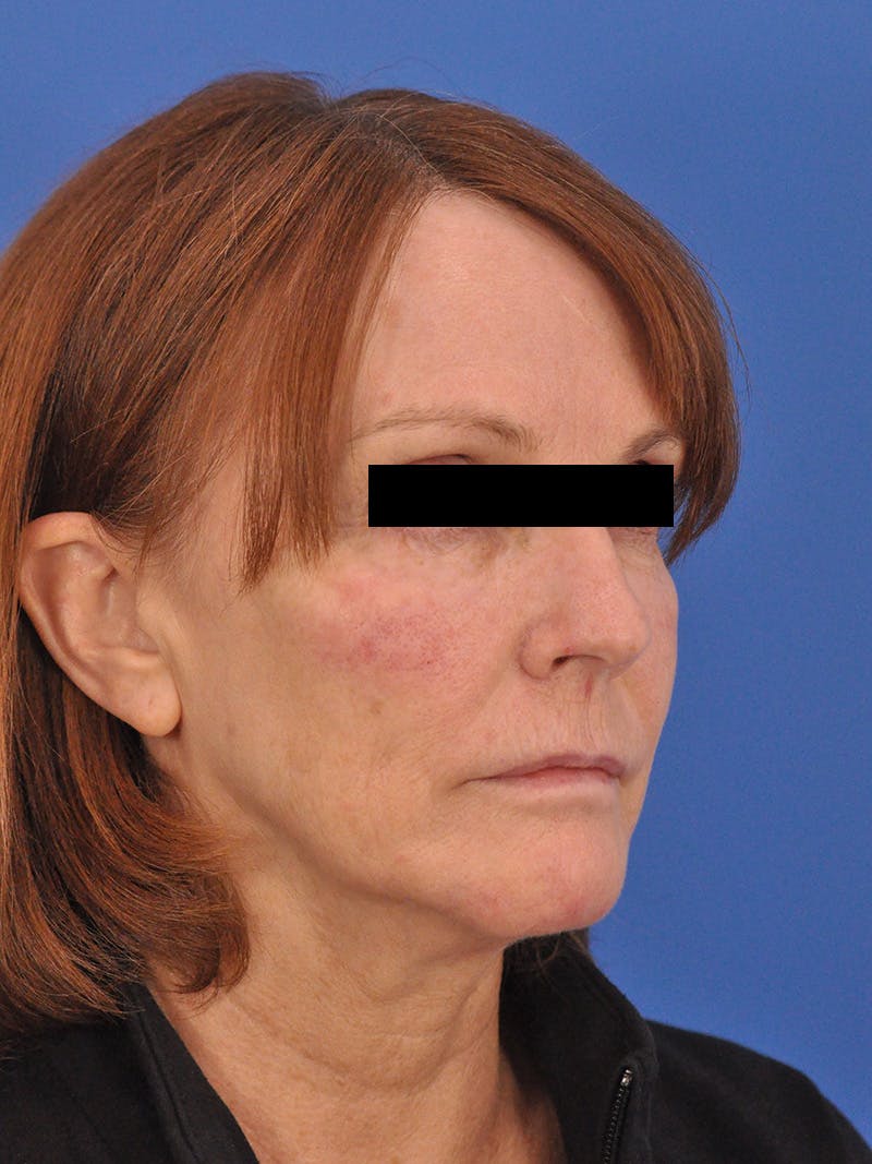 Chin Filler Before & After Gallery - Patient 206957 - Image 4
