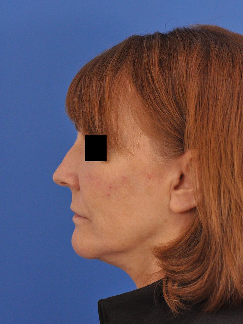 Chin Filler Before & After Gallery - Patient 206957 - Image 10