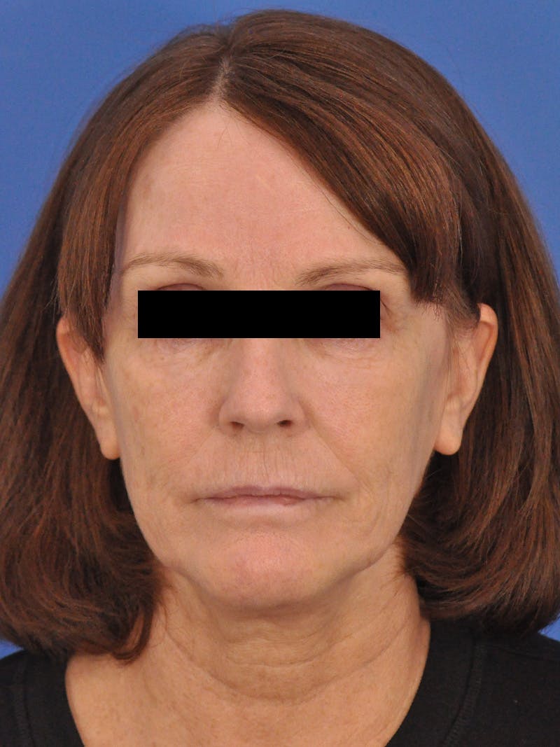 Chin Filler Before & After Gallery - Patient 206957 - Image 5