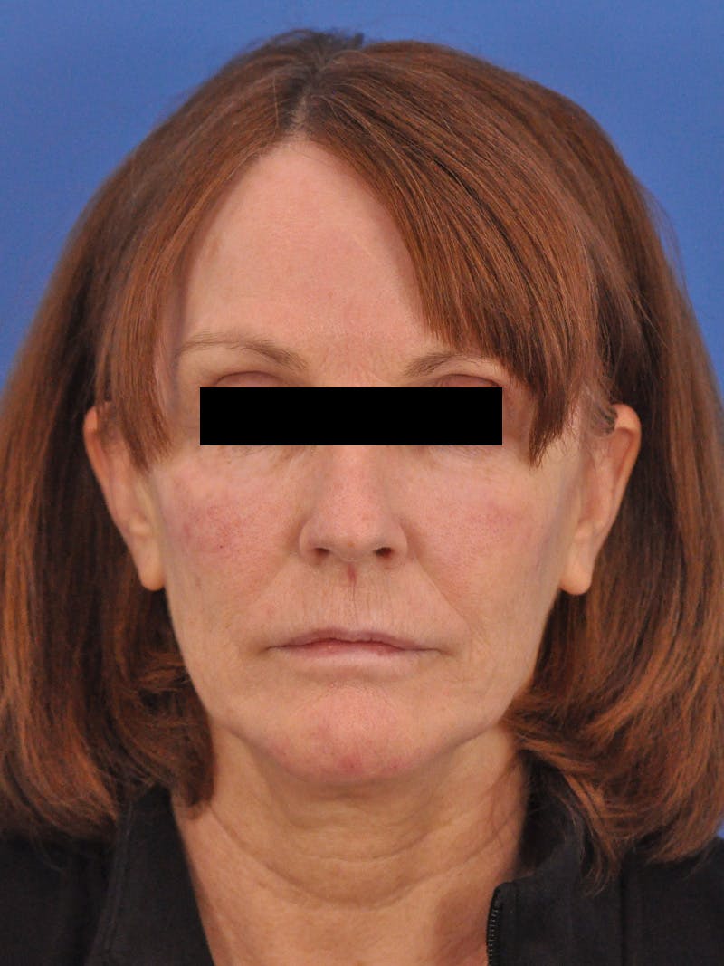 Chin Filler Before & After Gallery - Patient 206957 - Image 6