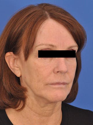 Cheek Filler Before & After Gallery - Patient 117652 - Image 4