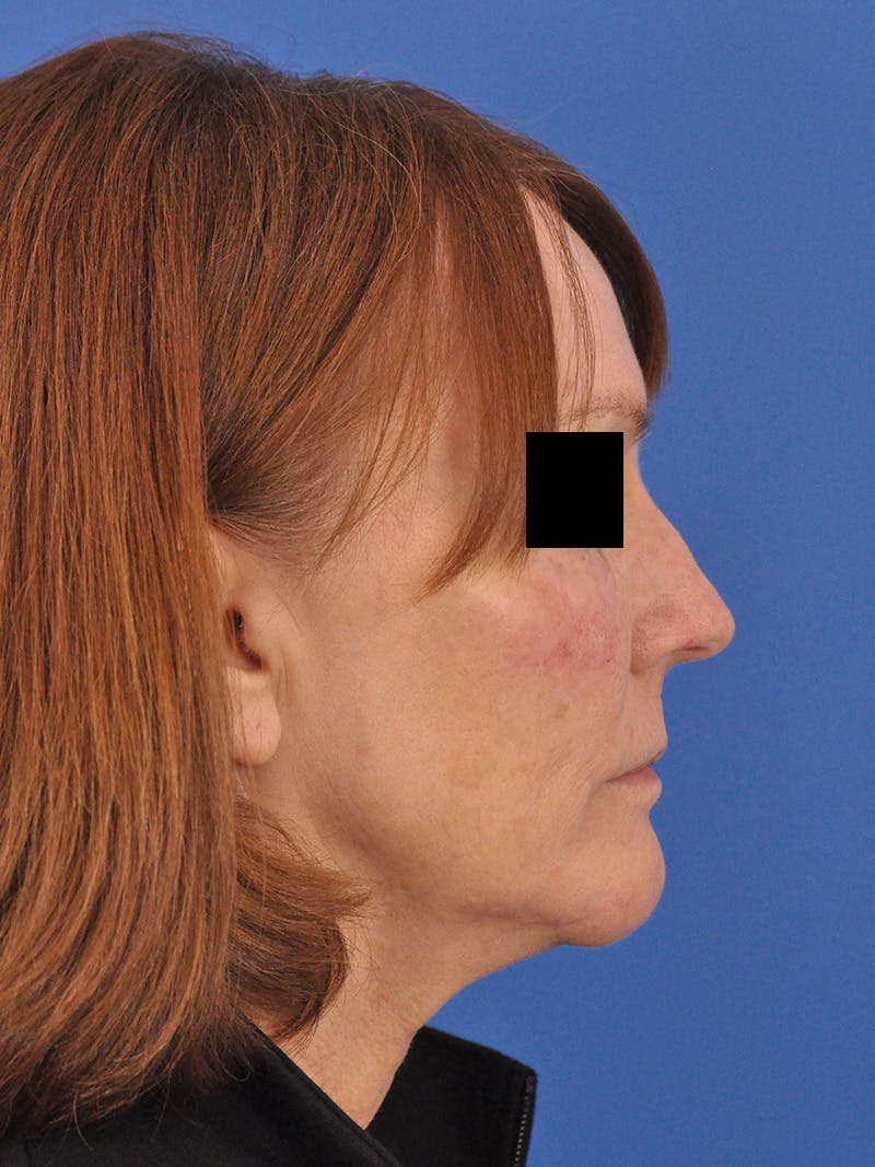 Chin Filler Before & After Gallery - Patient 206957 - Image 2