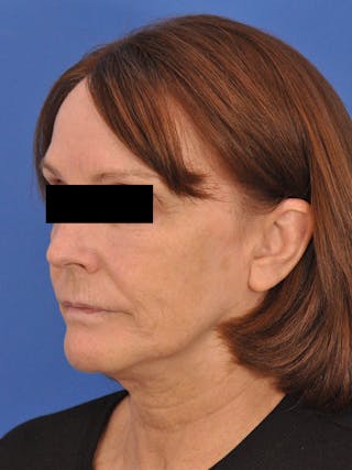 Chin Filler Before & After Gallery - Patient 206957 - Image 8
