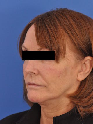 Cheek Filler Before & After Gallery - Patient 117652 - Image 8