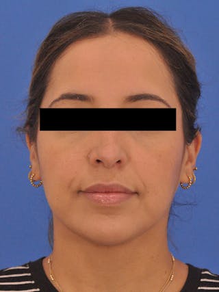 Neck Lift Before & After Gallery - Patient 317375 - Image 6