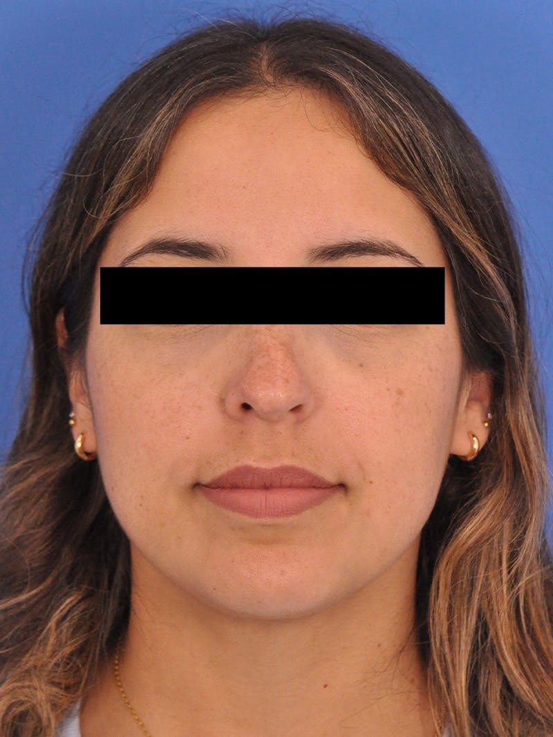 Neck Lift Before & After Gallery - Patient 317375 - Image 5