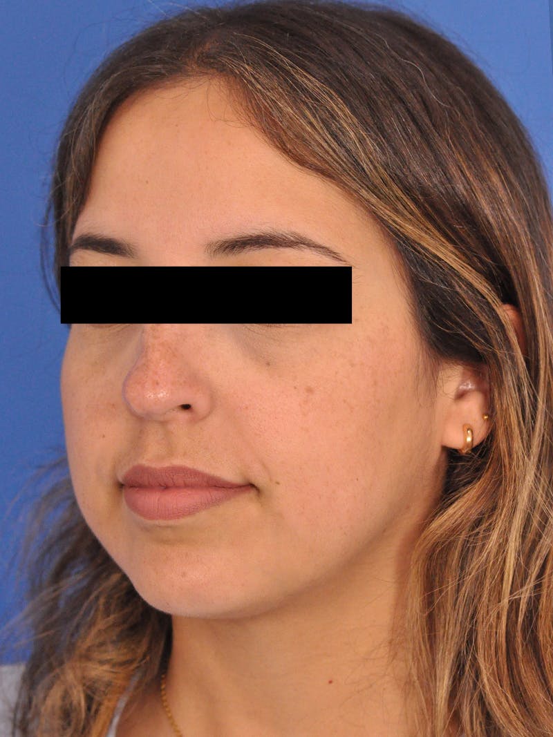 Neck Lift Before & After Gallery - Patient 317375 - Image 7