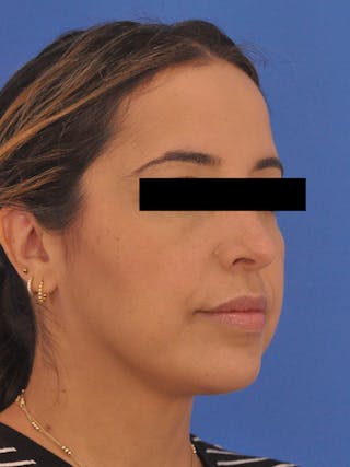 Neck Lift Before & After Gallery - Patient 317375 - Image 4