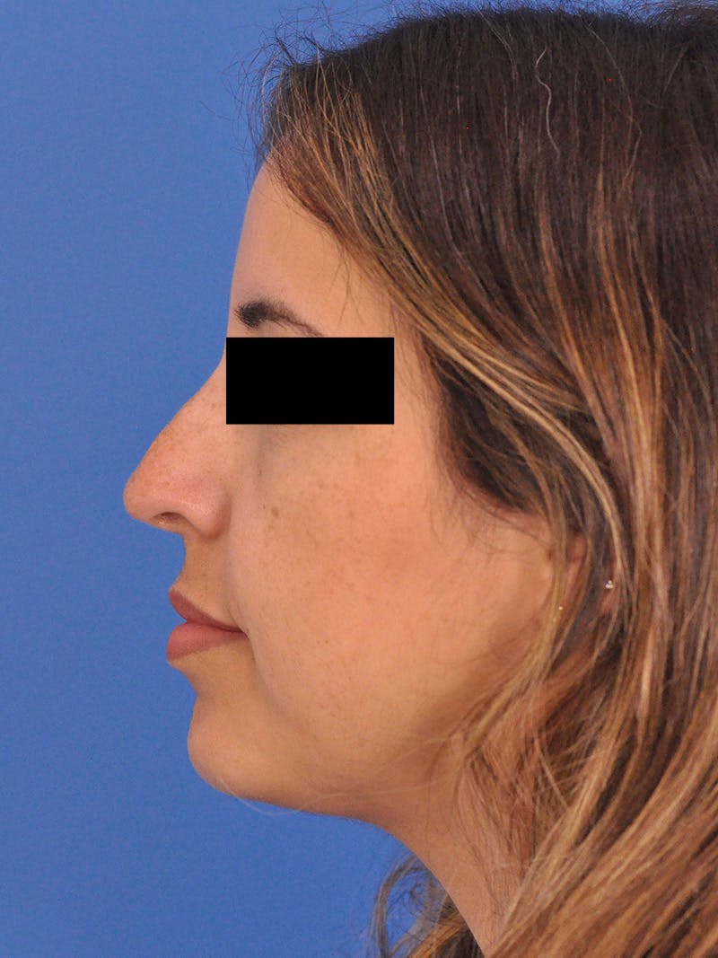 Neck Lift Before & After Gallery - Patient 317375 - Image 9