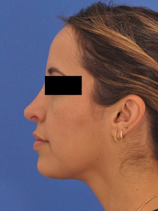 Neck Lift Before & After Gallery - Patient 317375 - Image 10