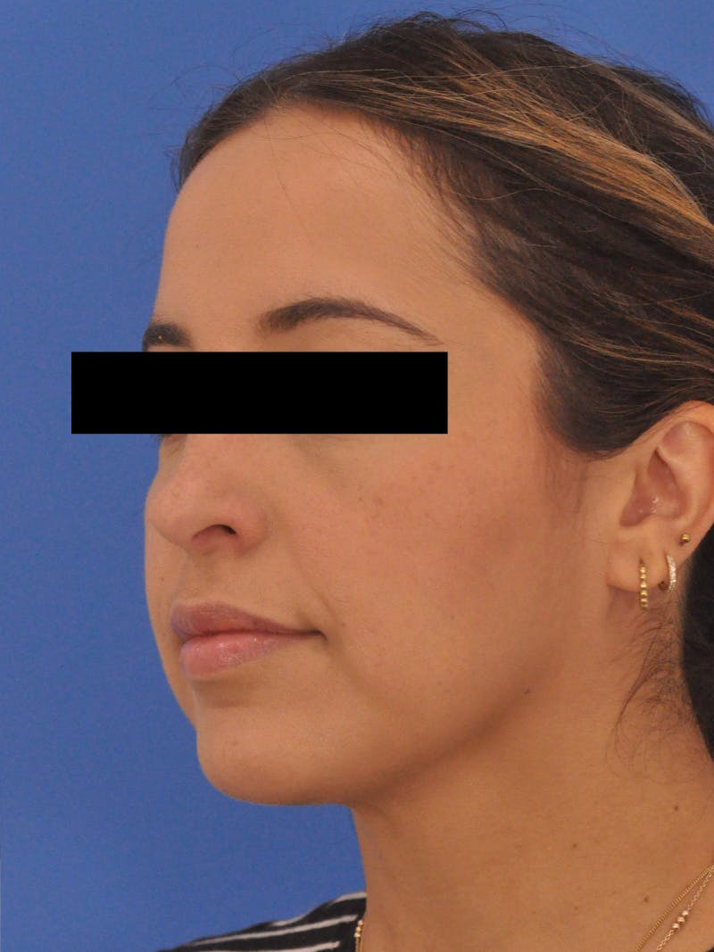 Neck Lift Before & After Gallery - Patient 317375 - Image 8