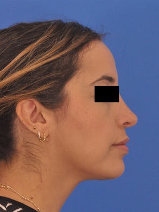Neck Lift Before & After Gallery - Patient 317375 - Image 2