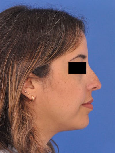 Neck Lift Before & After Gallery - Patient 317375 - Image 1