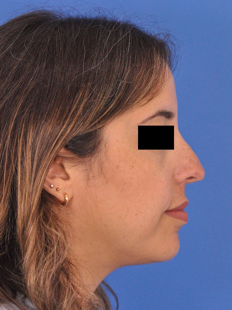 Neck Lift Before & After Gallery - Patient 317375 - Image 1
