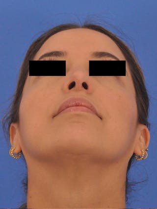 Neck Lift Before & After Gallery - Patient 317375 - Image 12