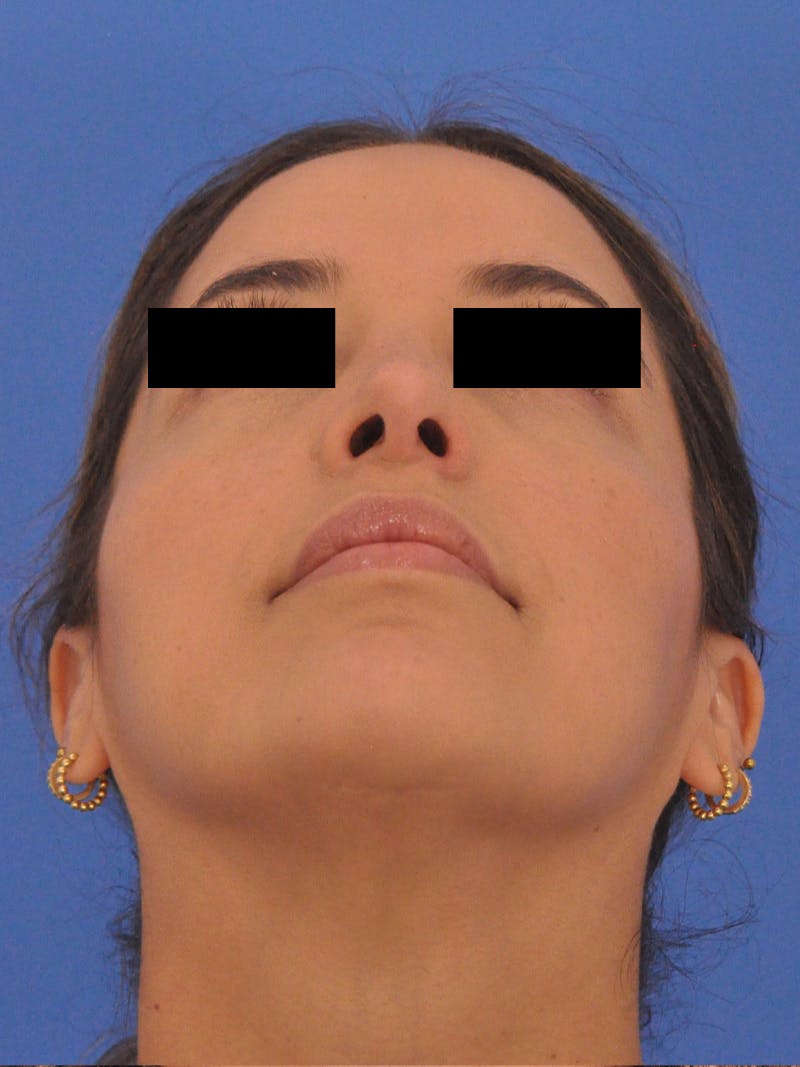 Neck Lift Before & After Gallery - Patient 317375 - Image 12
