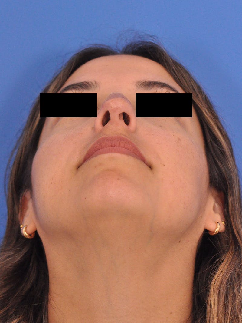 Neck Lift Before & After Gallery - Patient 317375 - Image 11