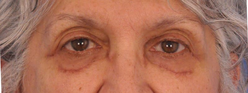 Blepharoplasty Before & After Gallery - Patient 246688 - Image 1