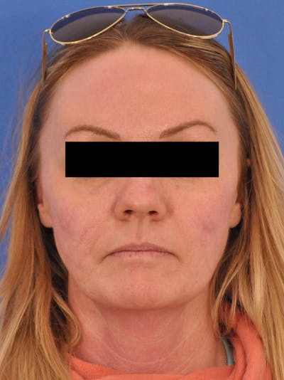 Acne Scars Before & After Gallery - Patient 147868 - Image 2