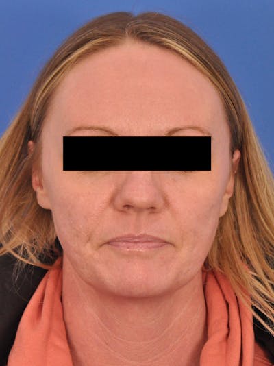 Acne Scars Before & After Gallery - Patient 147868 - Image 1