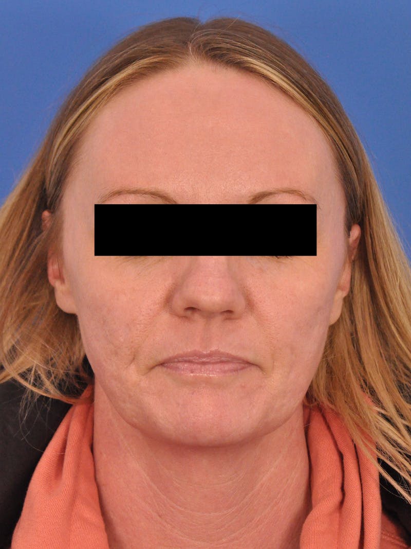 Acne Scars Before & After Gallery - Patient 147868 - Image 1