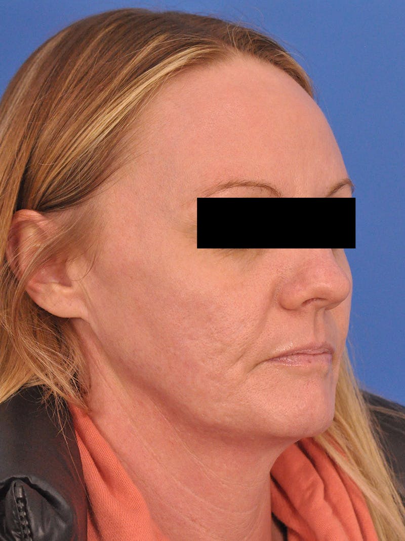 Acne Scars Before & After Gallery - Patient 147868 - Image 3