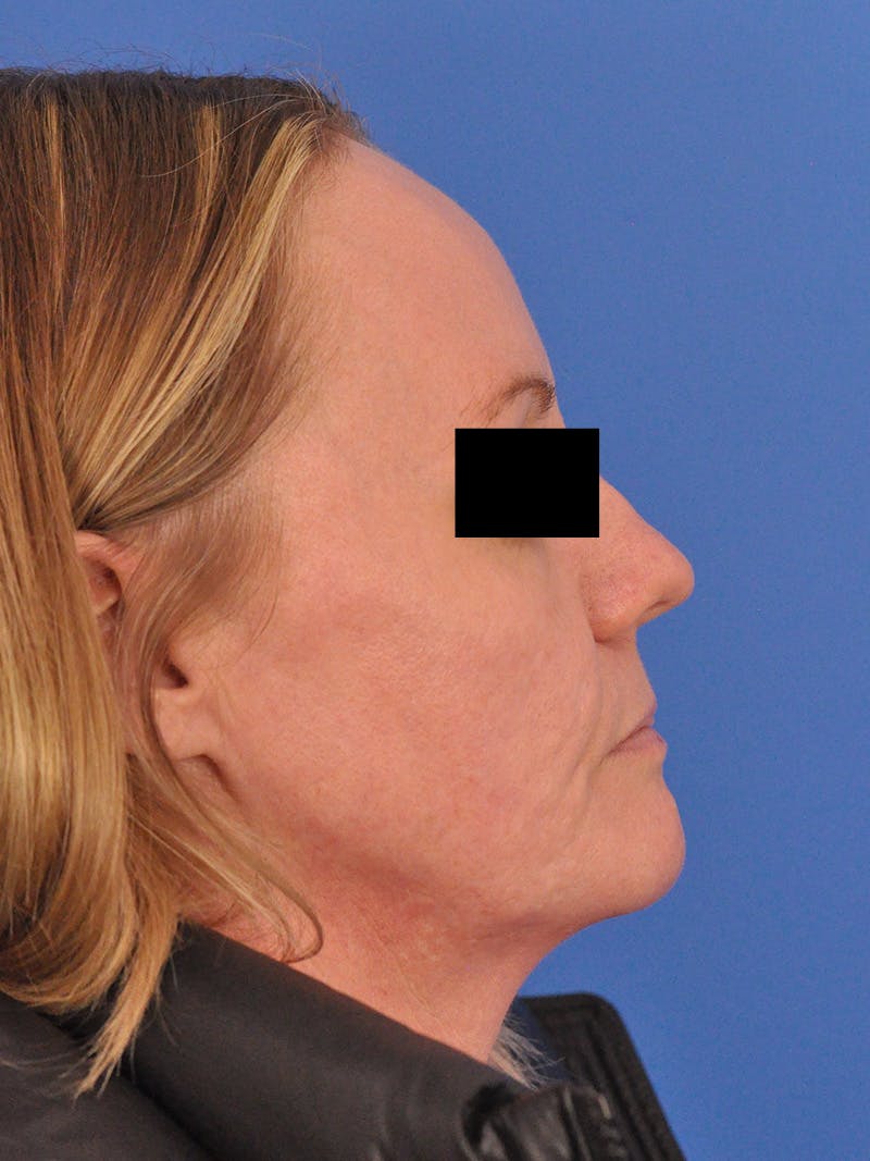 Acne Scars Before & After Gallery - Patient 147868 - Image 5