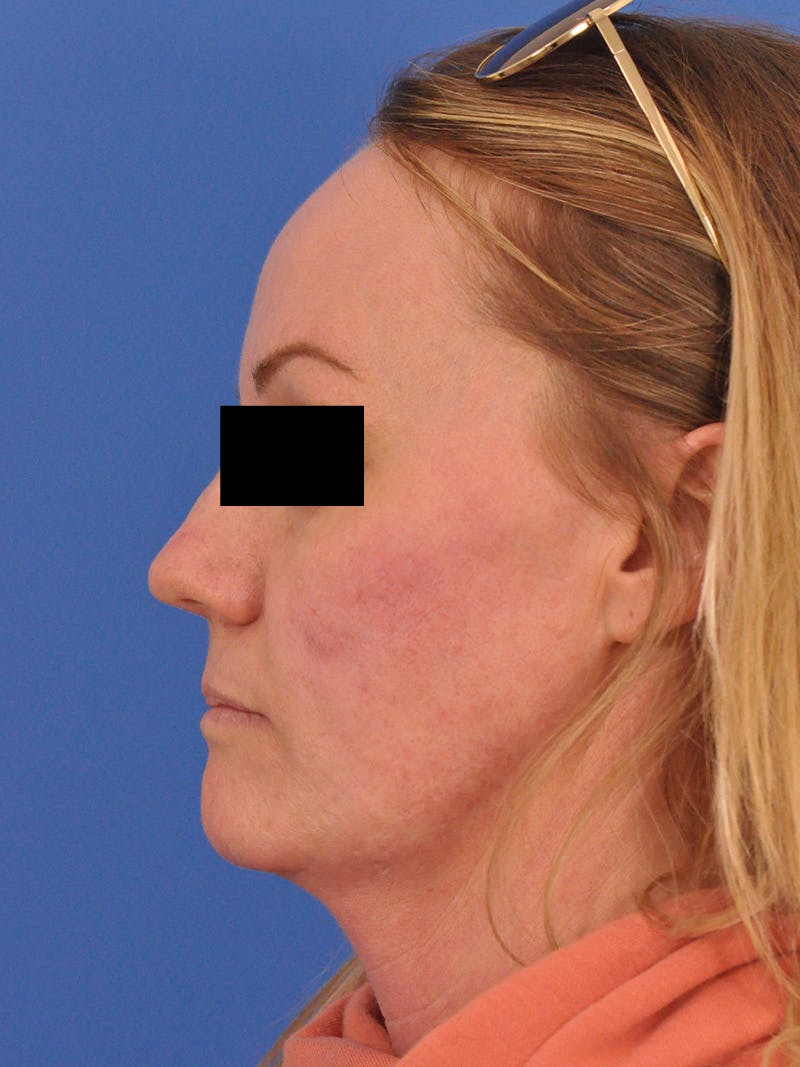 Acne Scars Before & After Gallery - Patient 147868 - Image 10