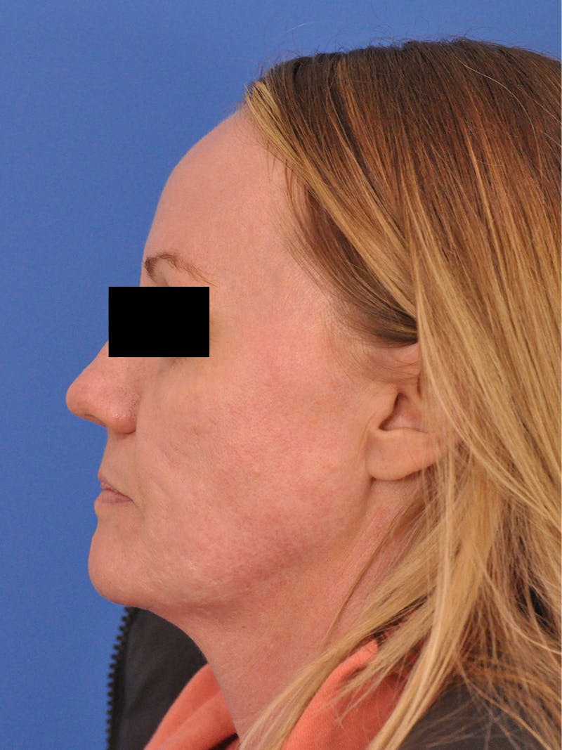 Acne Scars Before & After Gallery - Patient 147868 - Image 9