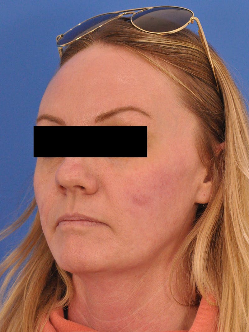 Acne Scars Before & After Gallery - Patient 147868 - Image 8