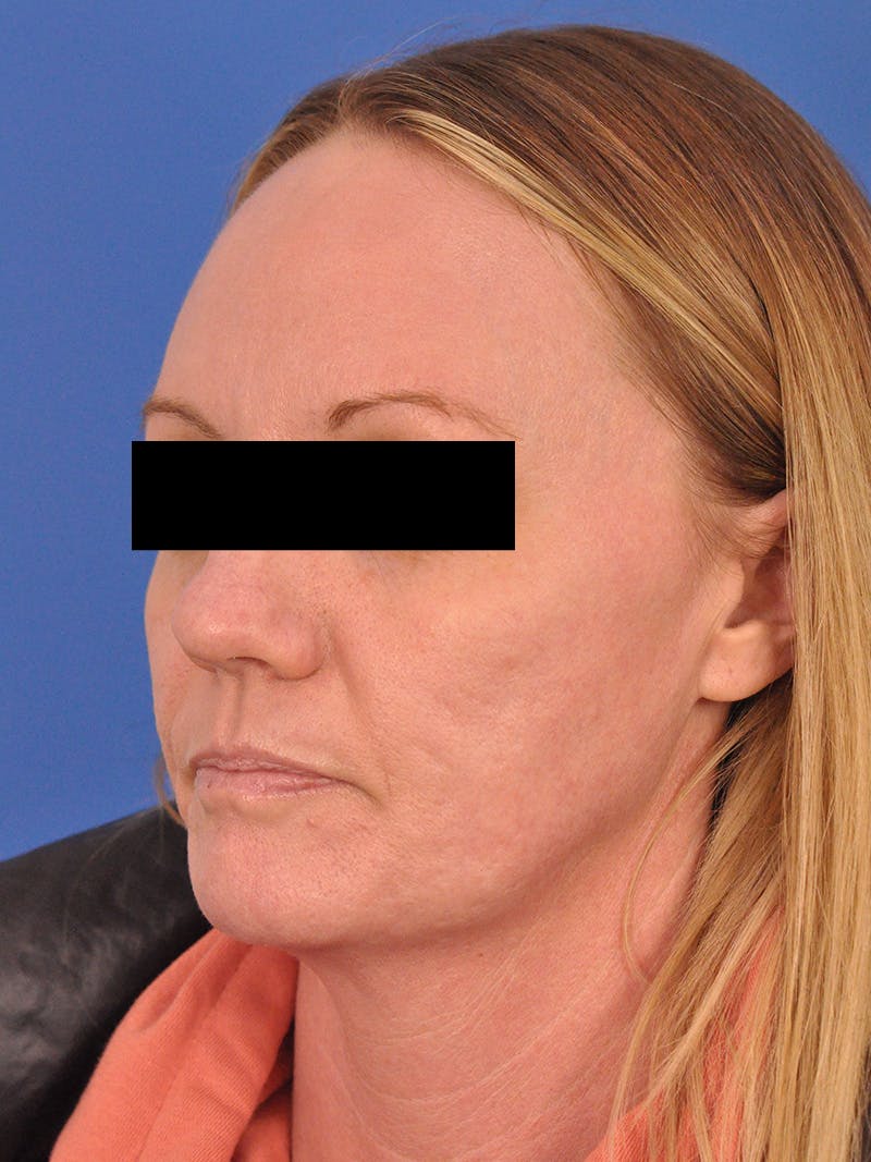 Acne Scars Before & After Gallery - Patient 147868 - Image 7