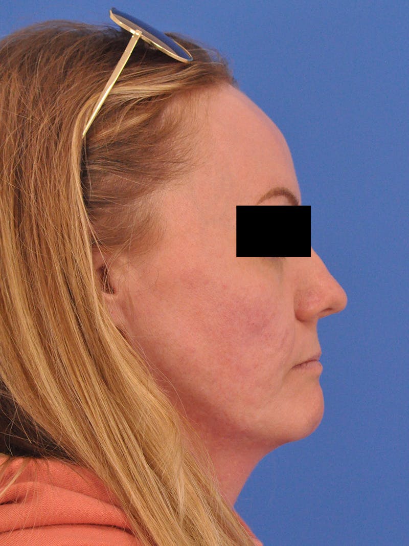 Acne Scars Before & After Gallery - Patient 147868 - Image 6