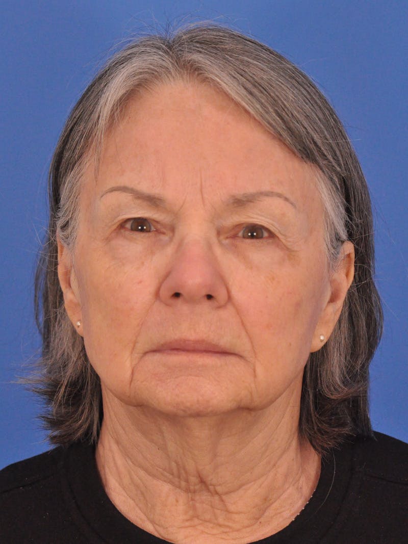 BBL & Moxi Before & After Gallery - Patient 412571 - Image 1