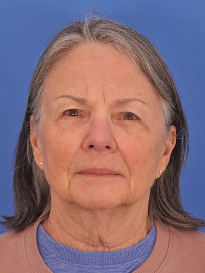 BBL & Moxi Before & After Gallery - Patient 412571 - Image 2